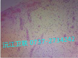 各類炎性細(xì)胞